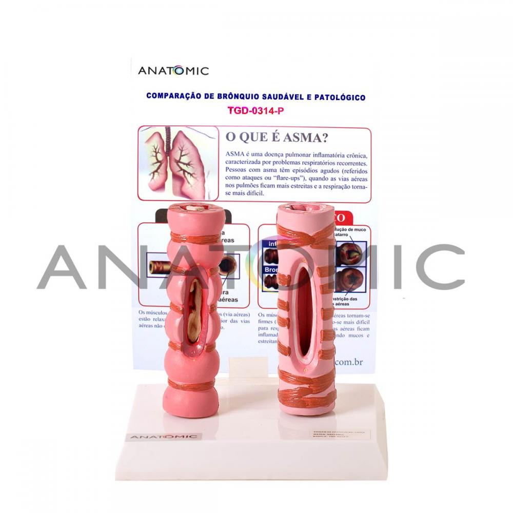 Comparação de Brônquio Saudável e Patológico
